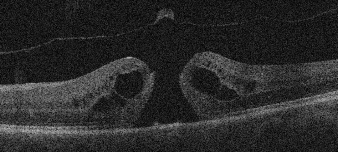 macular hole