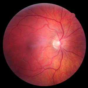 Two types of Macular Degeneration to watch for