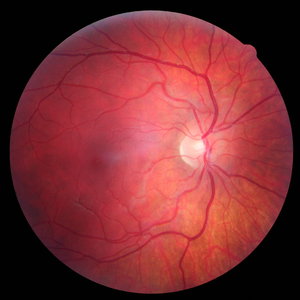 macular degeneration