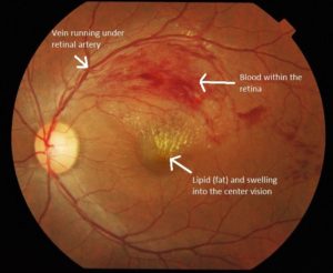 swollen retina blurred vision