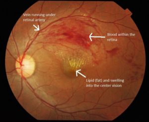 eye imagery showing the red veins running under the retinal artery, the yellowish cloud that is lipid (fat) and swelling in the the center of the eye, and a red cloud of blood within the retina