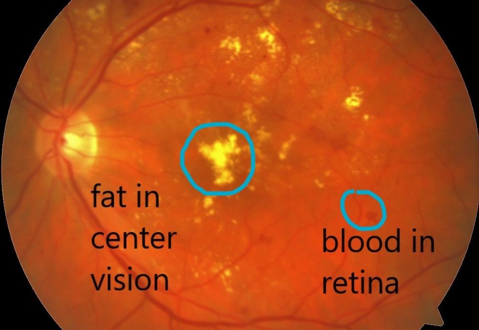 retinal edema chronic