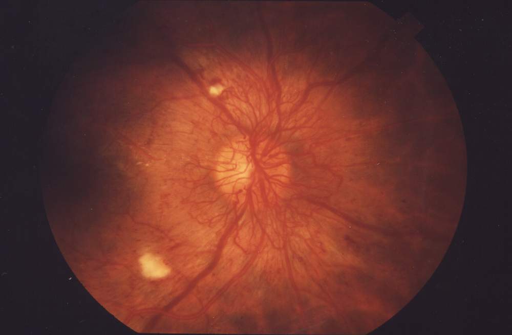 diabetic retinopathy