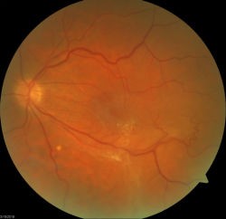 epiretina lmembrane macular pucker