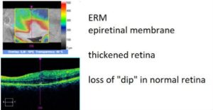 epiretina lmembrane macular pucker