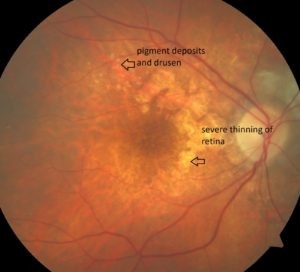 what is macular degeneration
