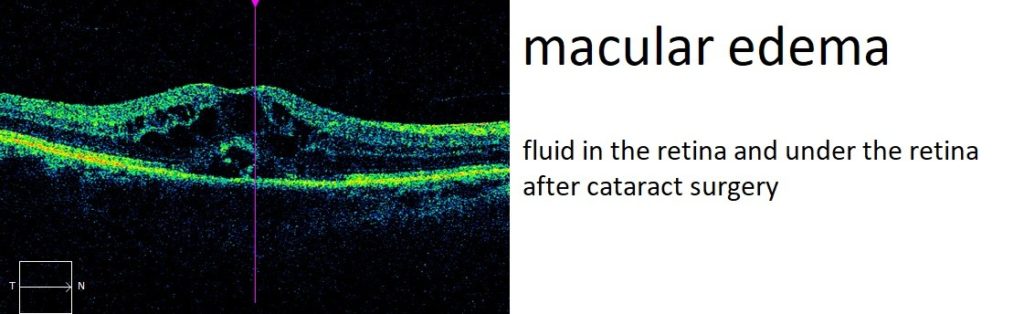 macular edema or ME