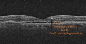 wet macular degeration