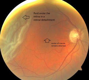 Retinal Detachment