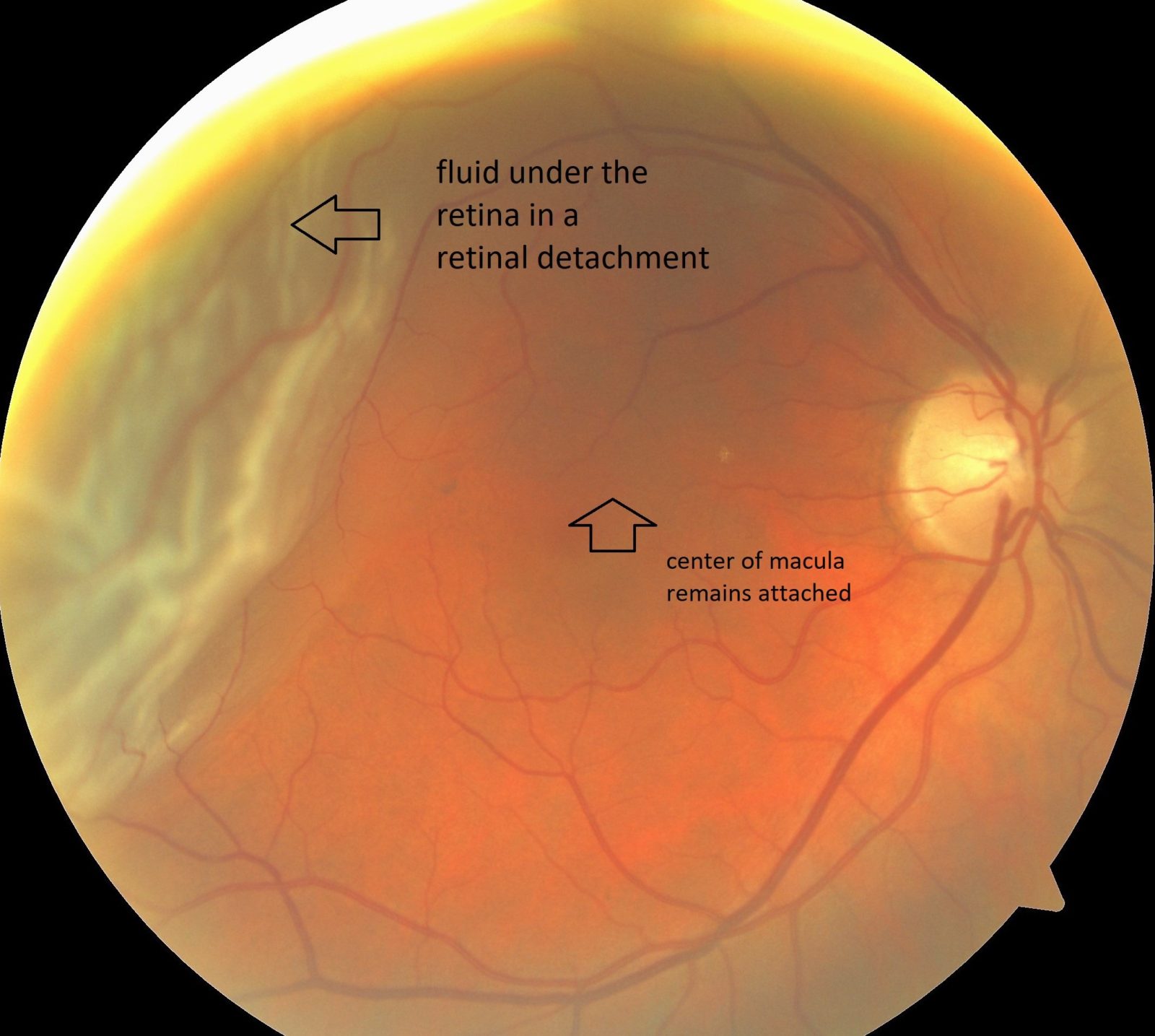 Retinal Detachment NYC - Vitreous Retina Macula Consultants of New