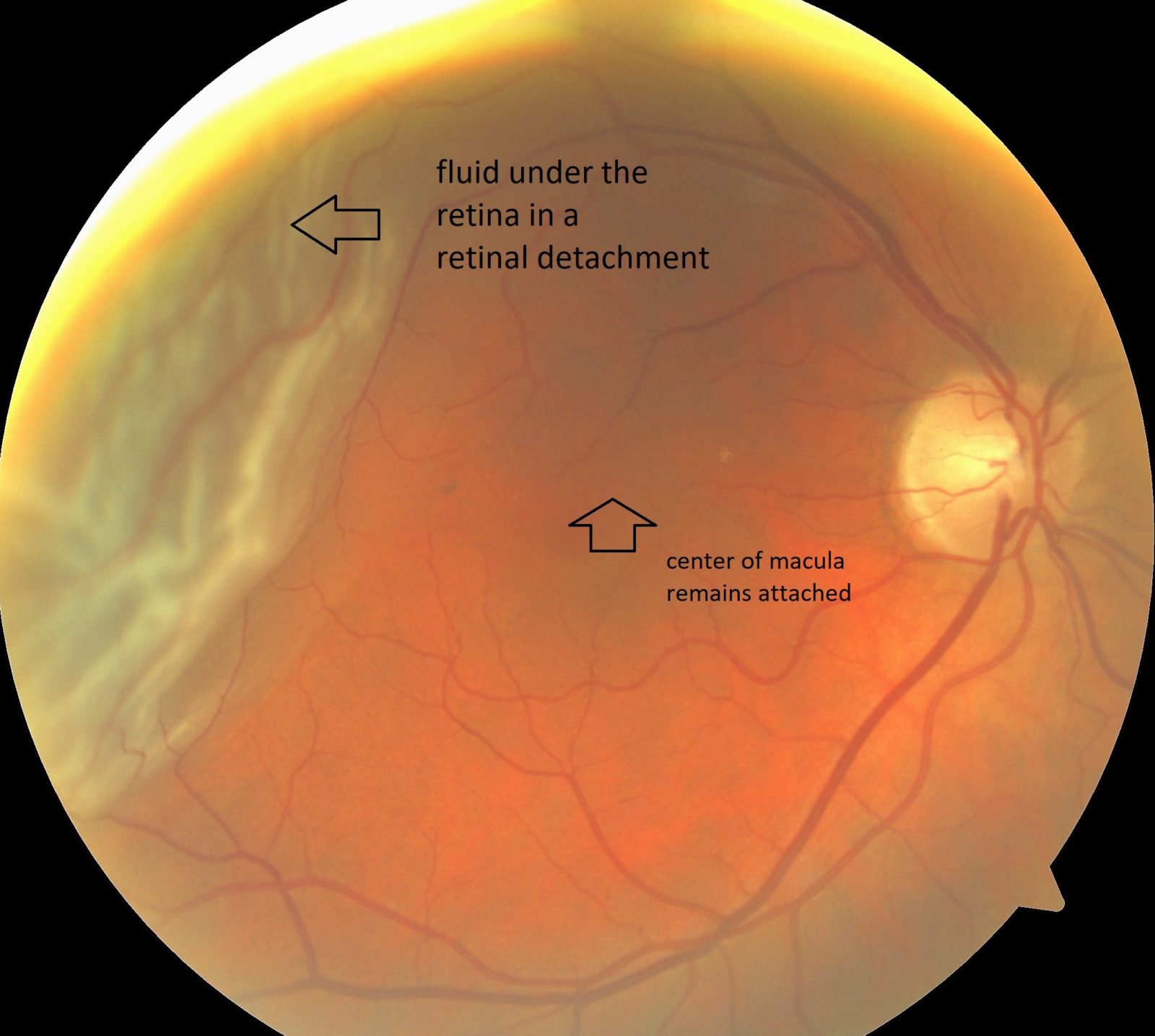 What is the Retina? Retinal detachment and other retinal issues.