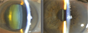 Cataract Before & After Cataract Surgery